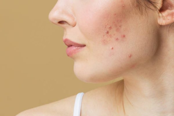 Say Goodbye to Acne: 10 Daily Habits for Clear Skin